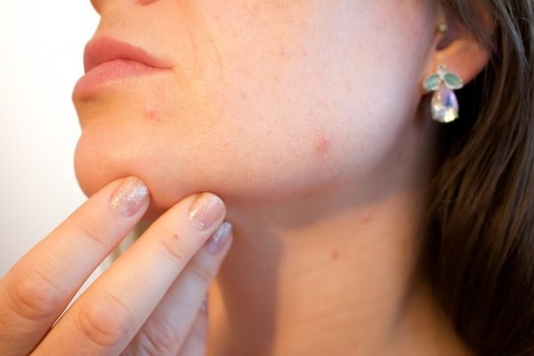 SUBCISION BENEFITS FOR TREATING ROLLING ACNE SCARS