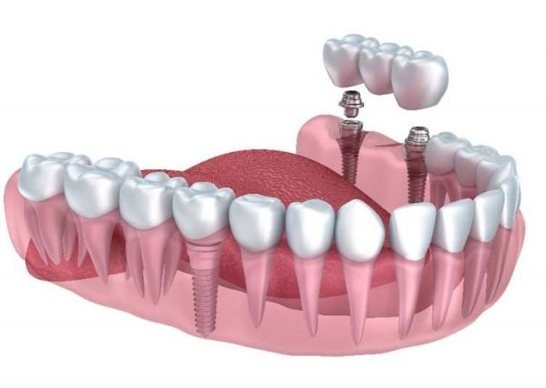 4 Top Reasons For Restoring Missing Teeth With Dental Implants