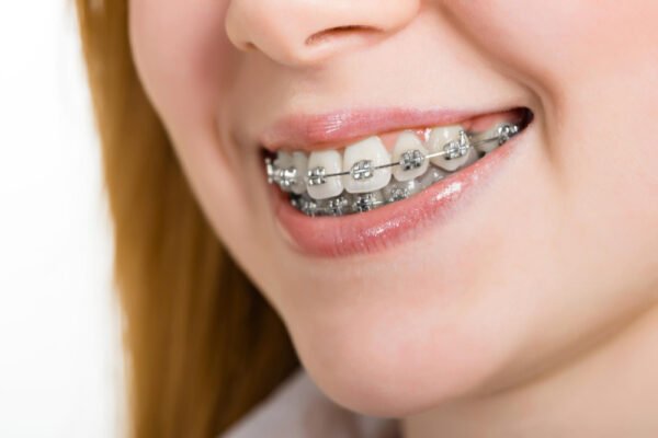 The Increasing Popularity of Self-Ligating Braces in Singapore
