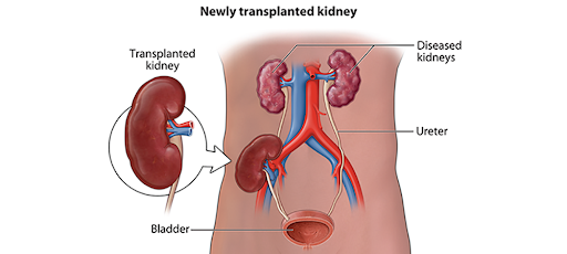 Why Kidney Transplant Is Better Than Long-Term Dialysis